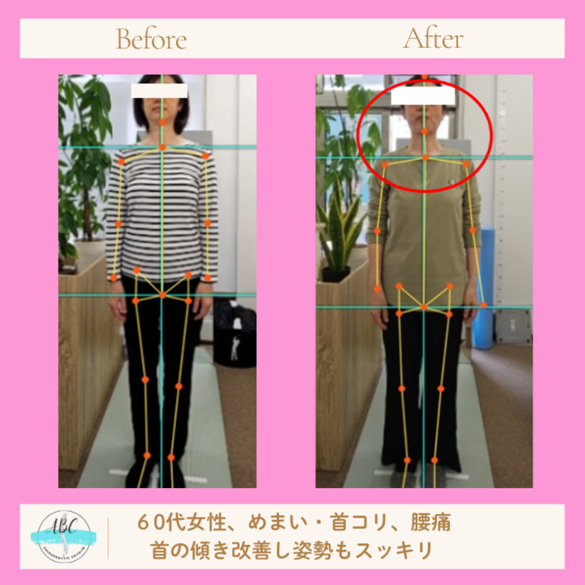 施術前と施術後の姿勢を比較した写真